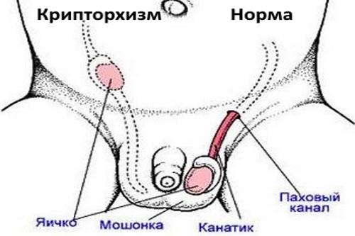 Коли у хлопчиків опускаються яєчка (в якому віці)?