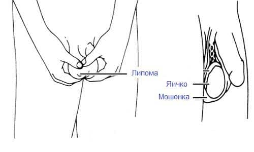 Коли варто звернутися до лікаря, якщо в паховій області у чоловіків (ліпома, атерома)