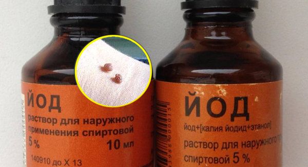 Кондиломи — показання до видалення, як правильно від них позбутися, щоб не нашкодити?