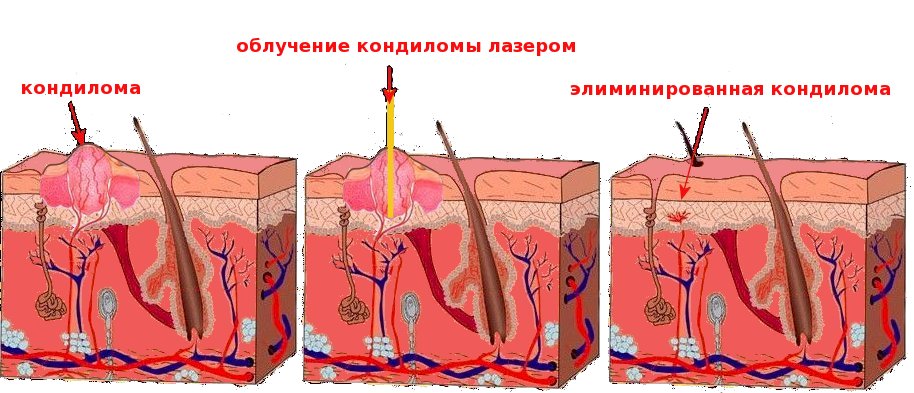 Кондиломи — показання до видалення, як правильно від них позбутися, щоб не нашкодити?