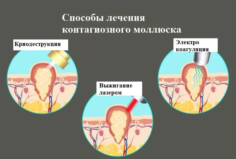 Контагіозний молюск — симптоми і методи лікування