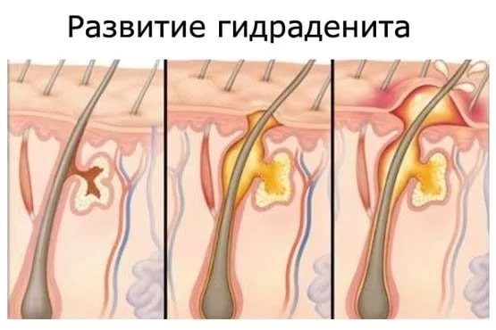 Лікування гидраденита під пахвою в домашніх умовах