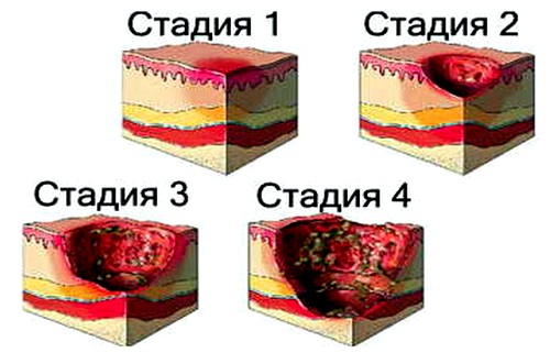 Лікування пролежнів у лежачих хворих у домашніх умовах