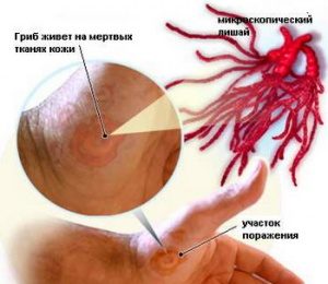 Лікування стригучого позбавляючи у людини в домашніх умовах