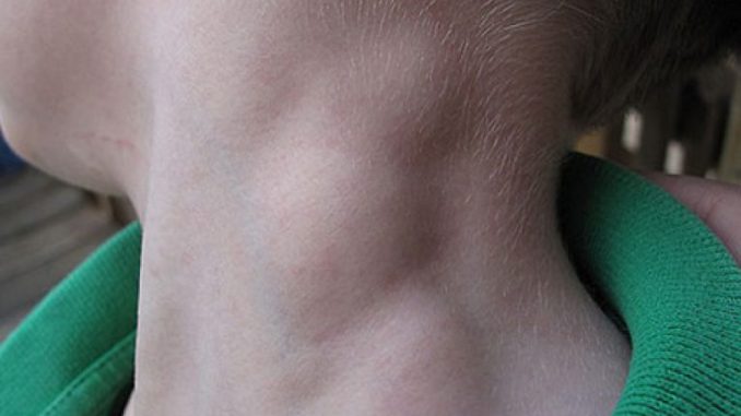 Лімфогранулематоз у дорослих і у дітей: фото, причини, прогноз