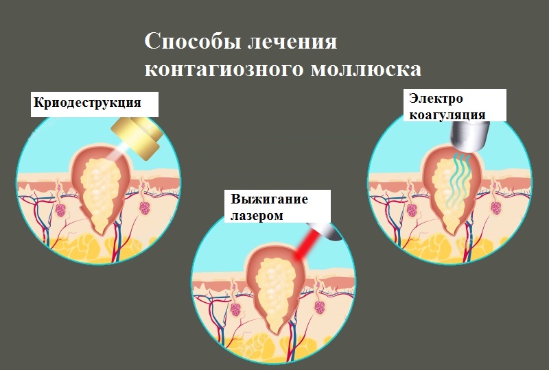 Народні засоби, ліки, мазі для лікування контагіозного молюска