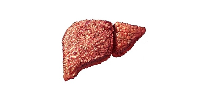 Наскільки страшний жировий гепатоз печінки і як його лікувати?