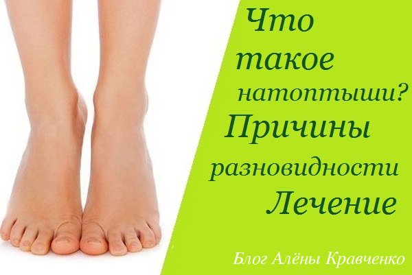 Натоптиші – що це таке? Як лікувати натоптиші в домашніх умовах