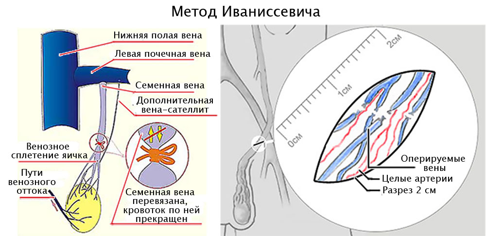 Операція Іваніссевіча при варикоцеле: що це таке?