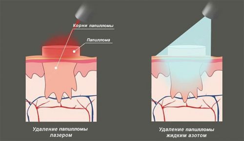 Папілома на спині — чому виникає і як лікувати?