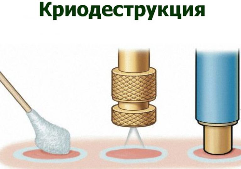 Папілома на столітті (оку) — як і хто її може видалити?