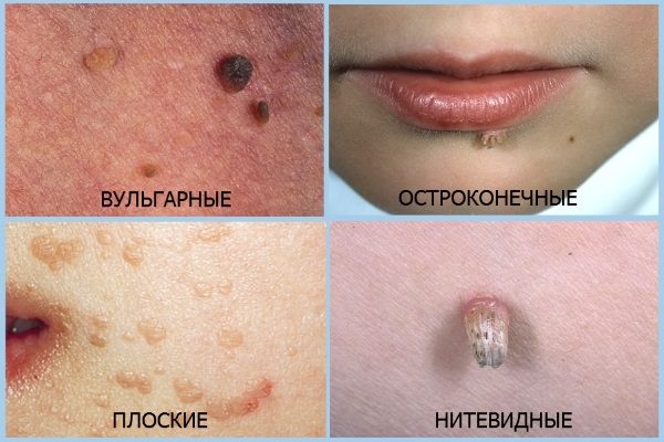 Папіломи на руках (пальцях і долонях) — 5 способів видалення