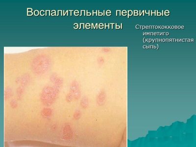 Пиодермит: симптоми, причини виникнення та способи лікування