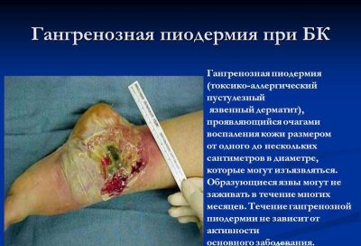 Пиодермит: симптоми, причини виникнення та способи лікування