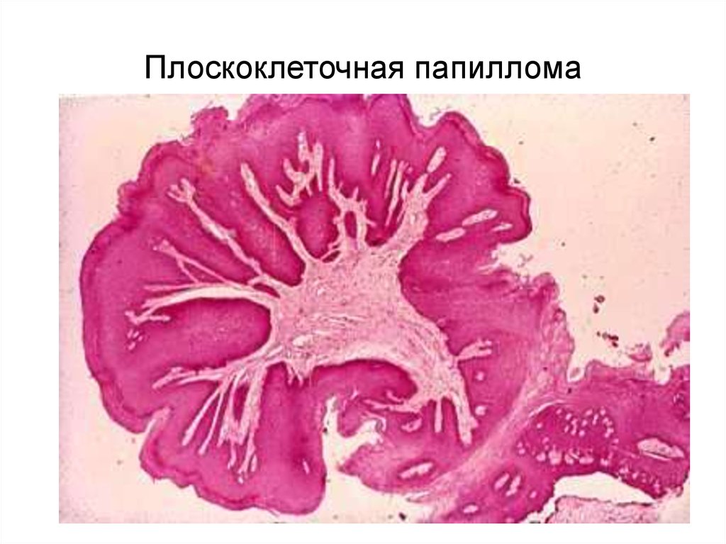 Плоскоклітинна папілома — 5 методів лікування і наслідки
