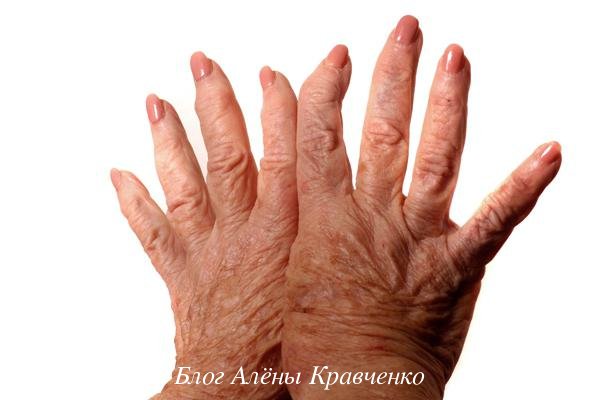 Подагра у жінок. ТОП 13 причини, ознаки, симптоми, лікування медикаментами і народними засобами