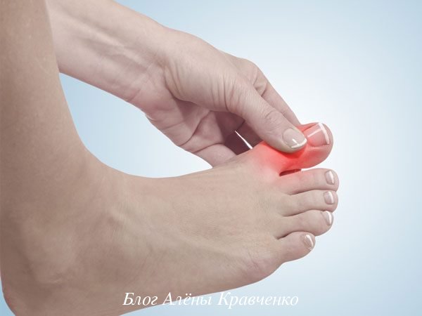 Подагра у жінок. ТОП 13 причини, ознаки, симптоми, лікування медикаментами і народними засобами