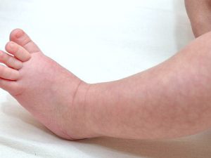 Причини мармурової шкіри у дитини грудного віку