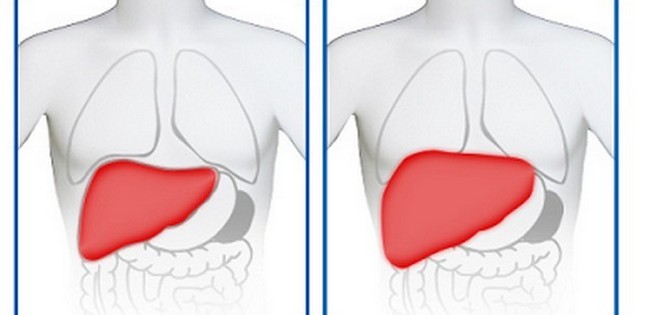 Причини, симптоми гепатомегалії та способи боротьби з нею