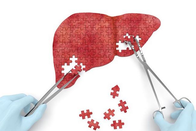 Причини, симптоми гепатомегалії та способи боротьби з нею