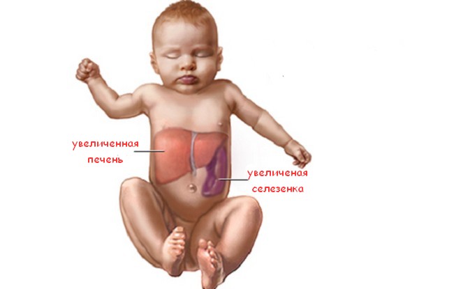 Причини, симптоми гепатомегалії та способи боротьби з нею