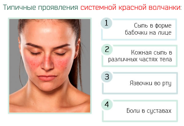 Причини, симптоми і лікування системного червоного вовчака