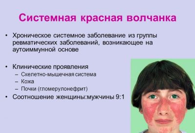 Причини, симптоми і лікування системного червоного вовчака