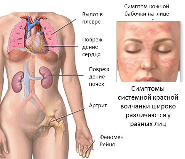 Причини, симптоми і лікування системного червоного вовчака