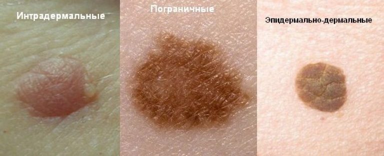 Родимки на лобі, щоках, очах, на голові у волоссі та ін
