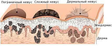 Родимки на лобі, щоках, очах, на голові у волоссі та ін