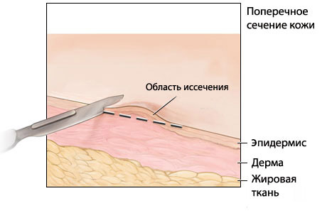 Родимки на лобі, щоках, очах, на голові у волоссі та ін