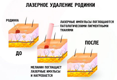 Родимки на лобі, щоках, очах, на голові у волоссі та ін