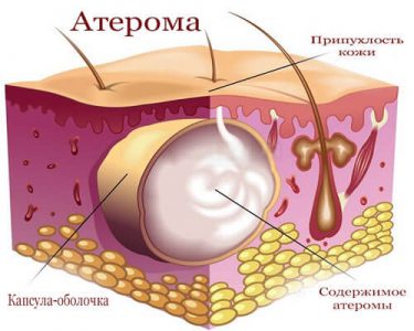 Що таке атерома і яким способом від неї можна позбутися?