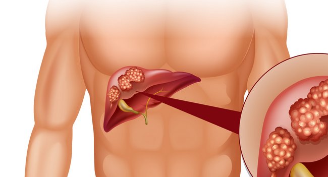 Що таке гемангіома печінки і як її можна вилікувати?