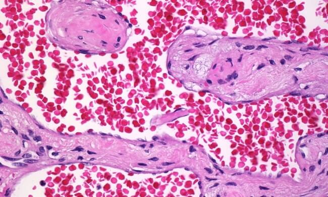 Що таке гемангіома печінки і як її можна вилікувати?