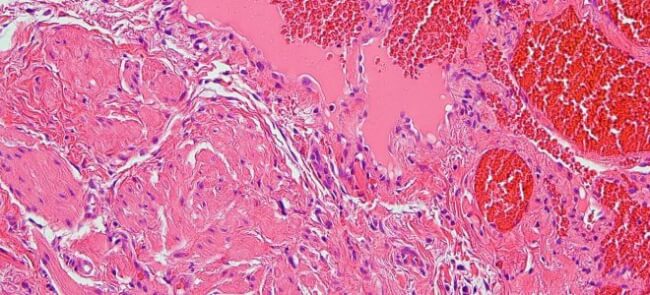 Що таке гемангіома печінки і як її можна вилікувати?