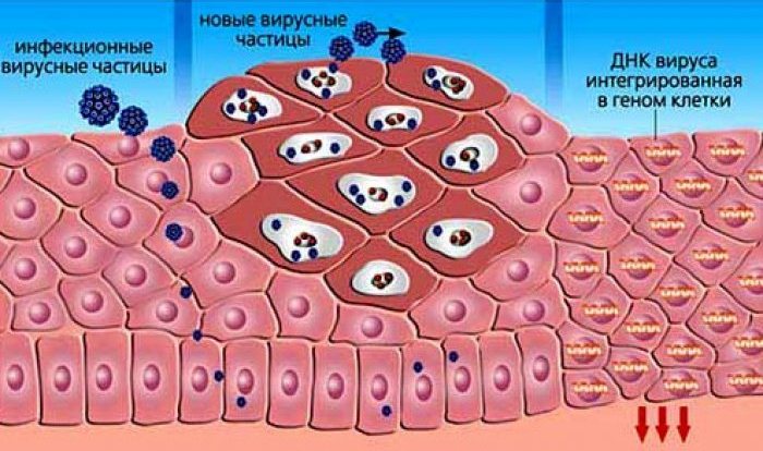 Що таке вірус папіломи 39 типу і як його лікувати?