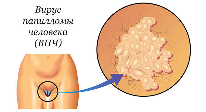 Що таке вірус папіломи людини — класифікація і лікування