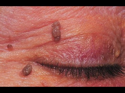 Що таке вірус папіломи людини — класифікація і лікування