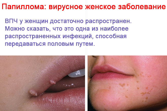 Що таке ВПЛ у жінок, в тому числі в гінекології