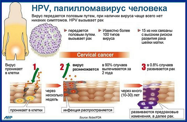 Що таке ВПЛ у жінок, в тому числі в гінекології