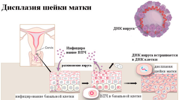Що таке ВПЛ у жінок, в тому числі в гінекології