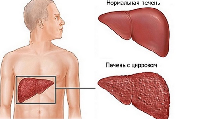 Симптоми та ознаки гепатиту «С» у чоловіків