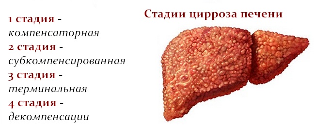 Скільки живуть з цирозом печінки?