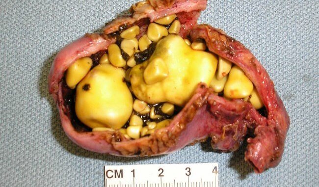 Способи лікування та профілактики нападів жовчнокам’яної хвороби