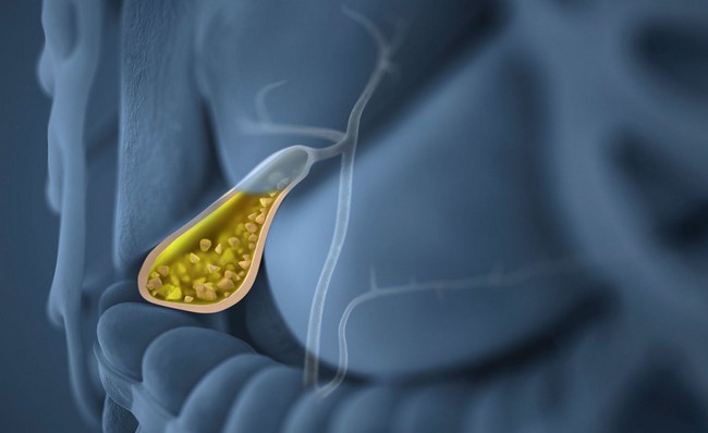 Способи лікування та профілактики нападів жовчнокам’яної хвороби