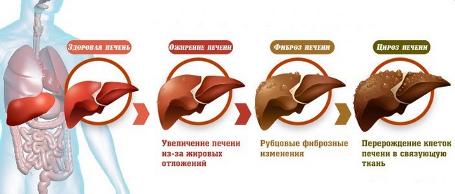 Стеатоз печінки: що це таке і з-за чого з’являється?