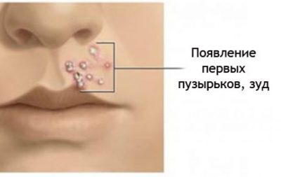 Стрептодермія: як розпізнати і вилікувати хворобу?