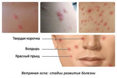 Стрептодермія: як розпізнати і вилікувати хворобу?