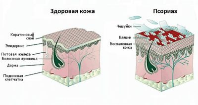 Таклонекс від псоріазу: інструкція по застосуванню, аналоги.